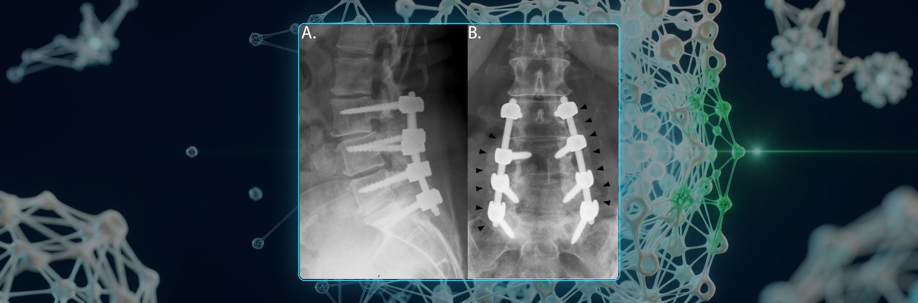 L3-S1 posterior instrumented fusion radiographs at 13 months, bony fusion annotated